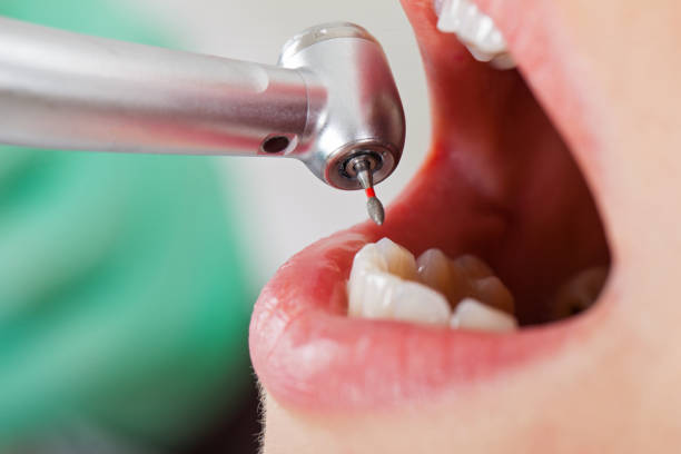 Best Emergency Treatment for Dental Infections or Abscesses in Pueblo West, CO